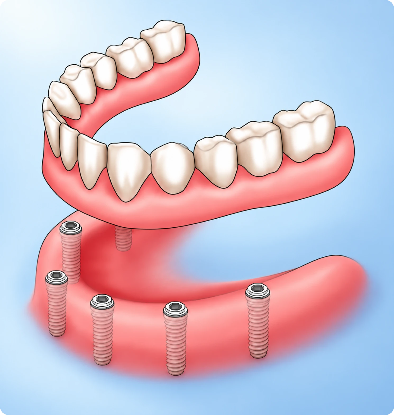 lleveza lifetime guarantee on full-arch dental implants