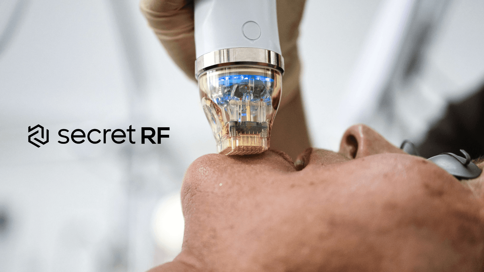 RF-Microneedling: Radiofrequenz-Mikronadelung erklärt