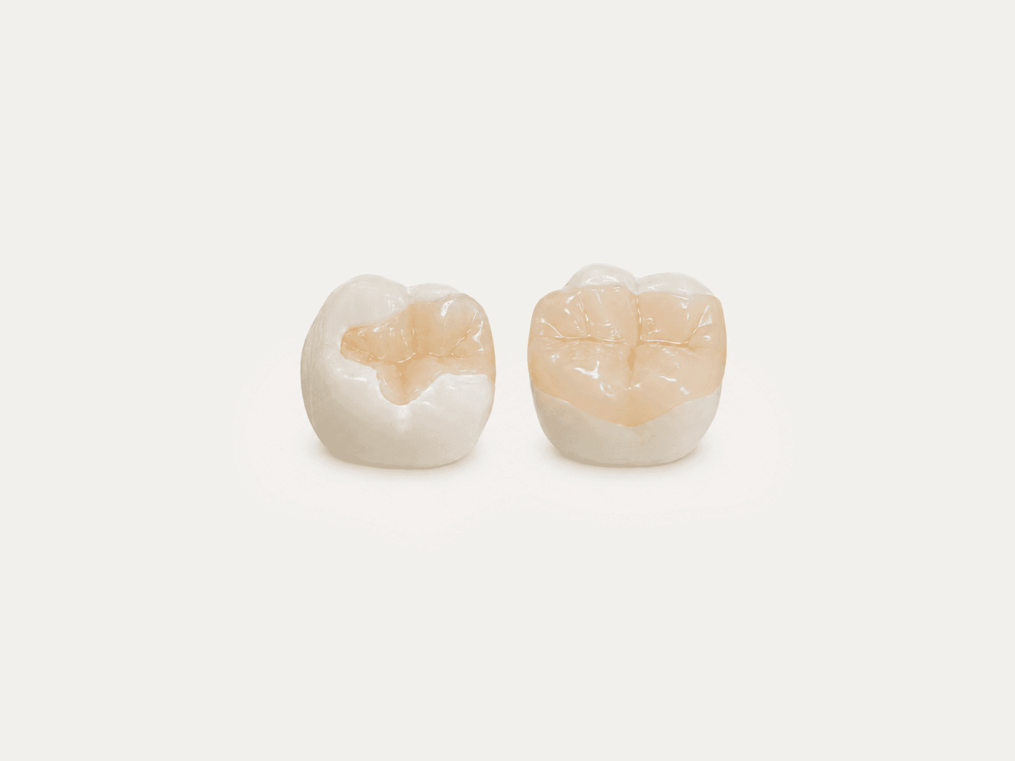 Two molar teeth with ceramic inlay restorations
