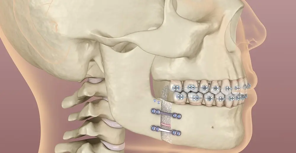 Cirurgia Ortognática: Descubra o que é?