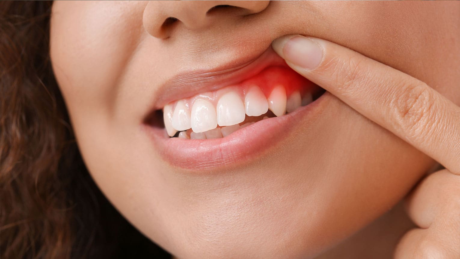 Gum Disease Treatment Rochelle Park