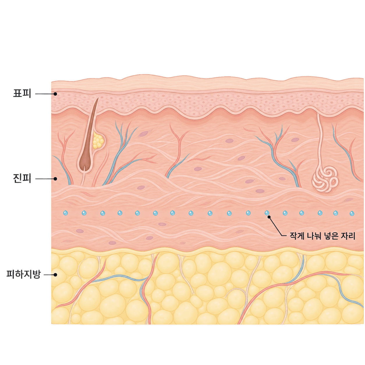 아주 작은 양을 진피 안에 촘촘히 나눠 넣어요