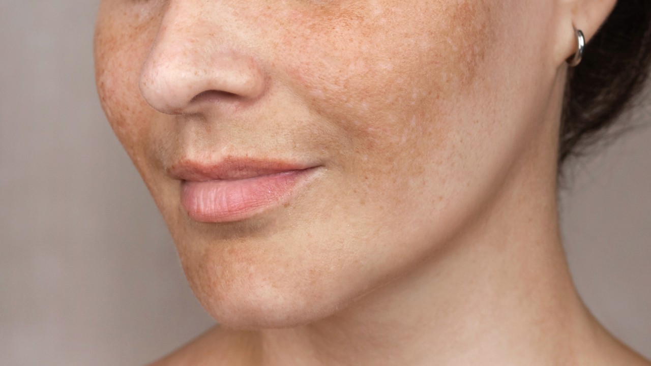 Women with hyperpigmentation on the skin