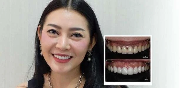 Dental crown before and after restoration at COSDENT Smile Design