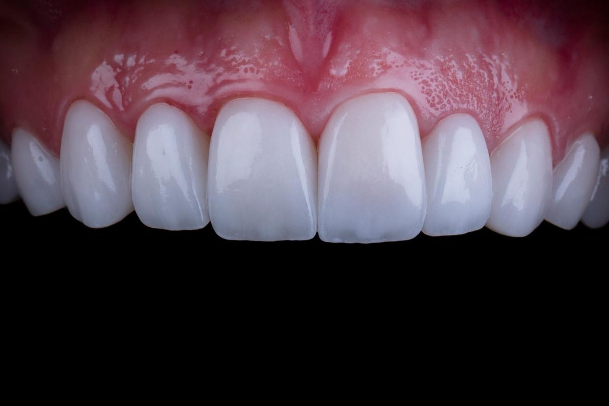 veneers