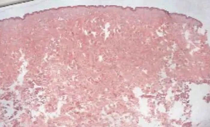 Histologischer Schnitt der tiefen Dermis direkt nach der RF-Microneedling-Behandlung – gezielte Koagulation