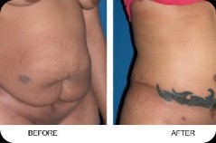 Before and after of surgery image