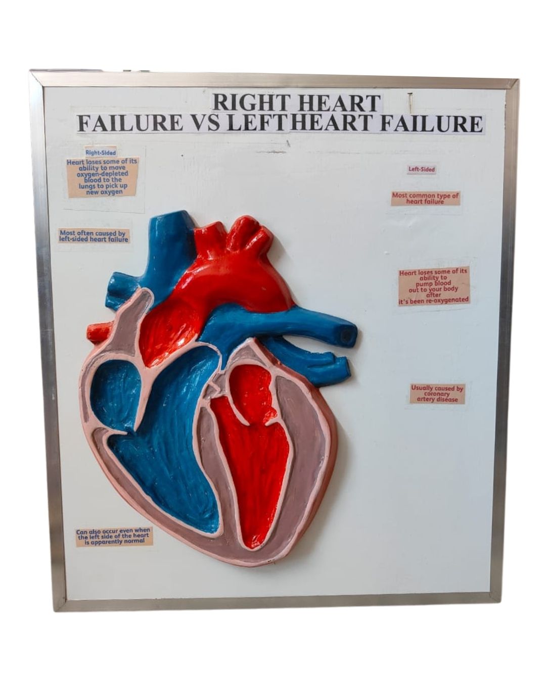 Right Heart Failure vs Left Heart Failure Model