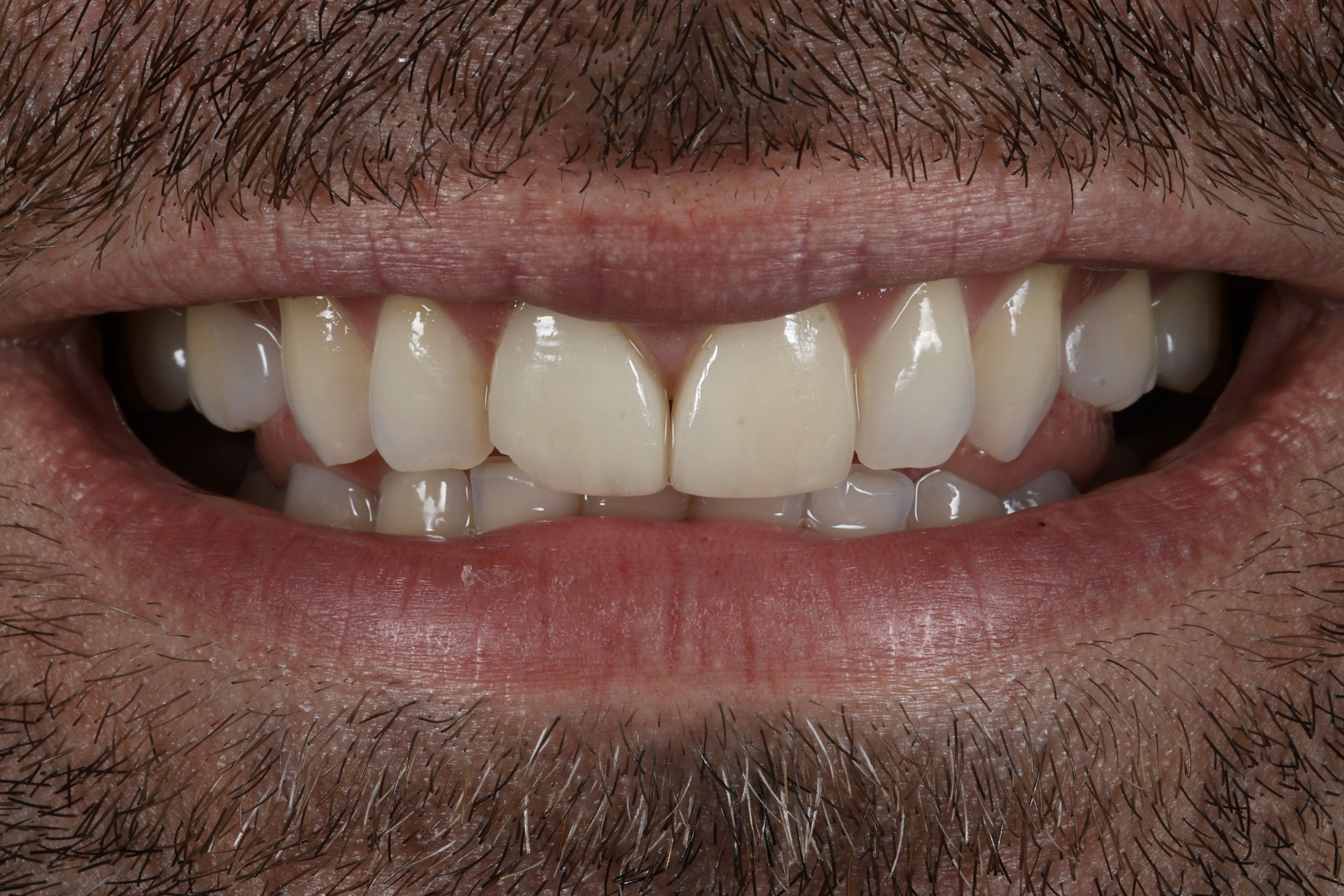 Crowns + Veneers, Smile redesign · Full mouth rehabilitation - before treatment