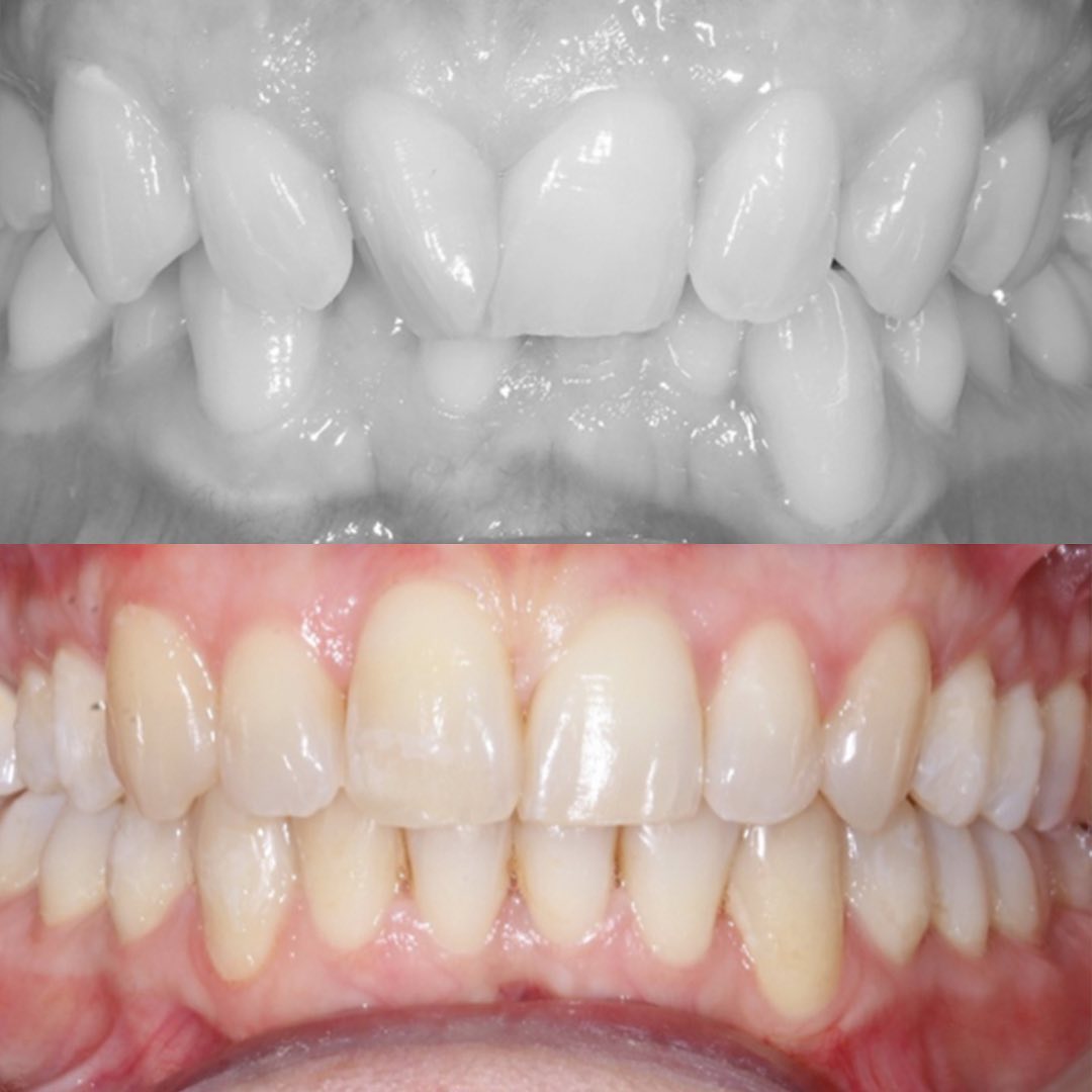 Invisalign® before and after at Invisalign Center, showing the improvement of severely crooked front teeth into perfect alignment.