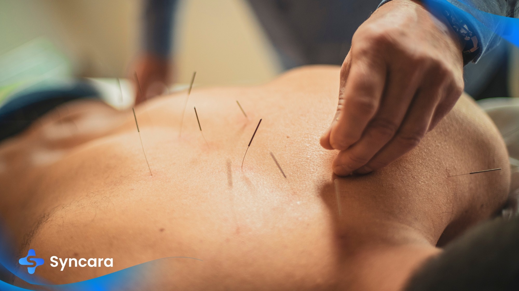 Toronto acupuncturist performing acupuncture therapy