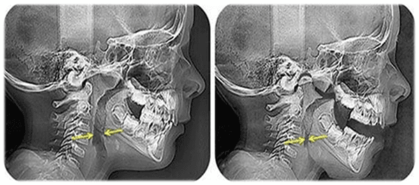 X-Ray showcasing jaw and airway