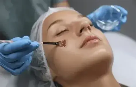 Aesthetician applying chemical peel solution with a brush to exfoliate dull skin and promote a smoother, radiant complexion.
