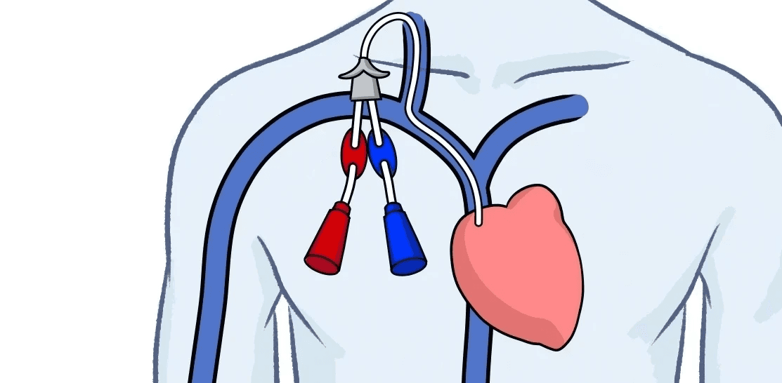 투석관 일러스트