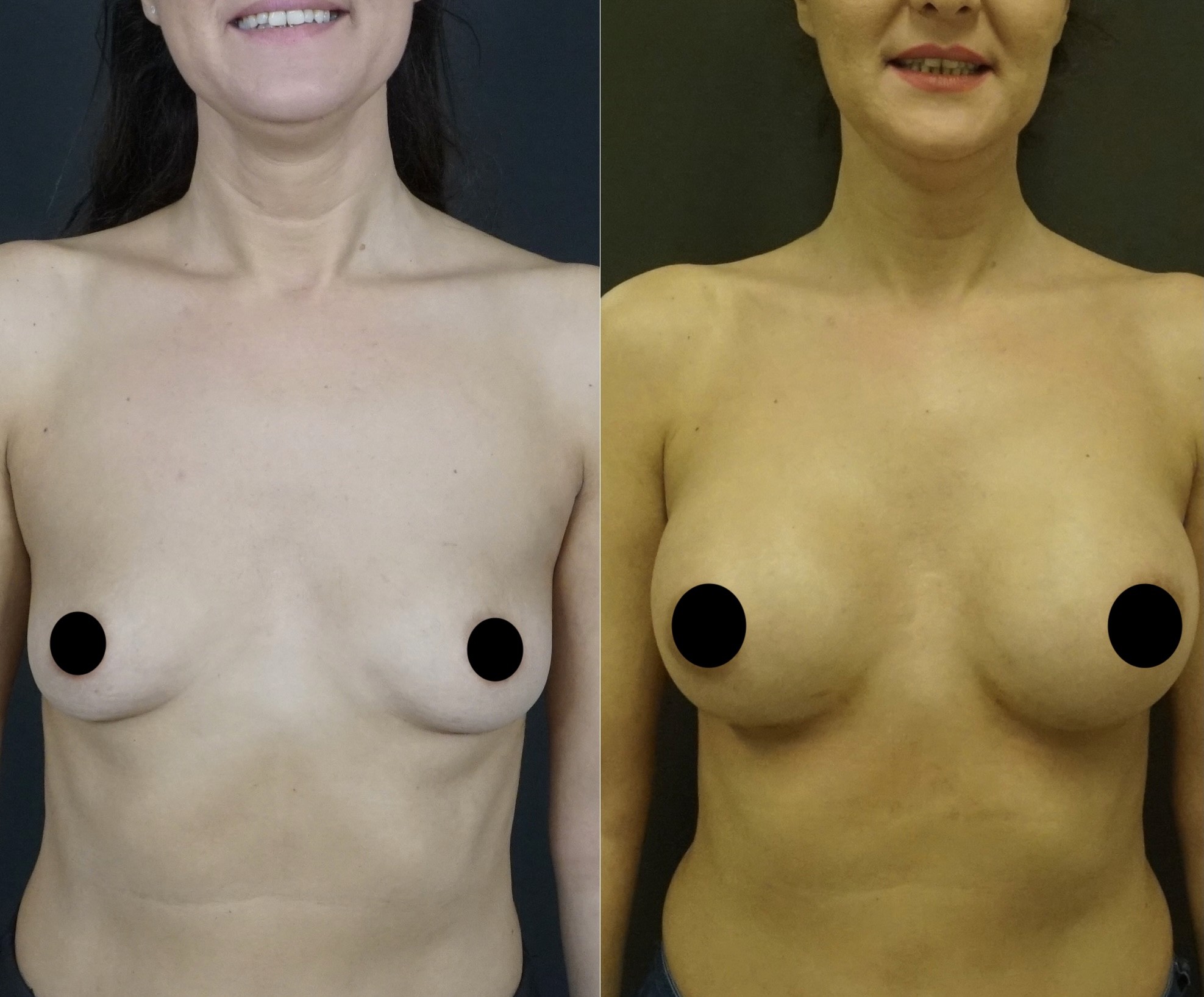 breast augmentation 4 months result front view