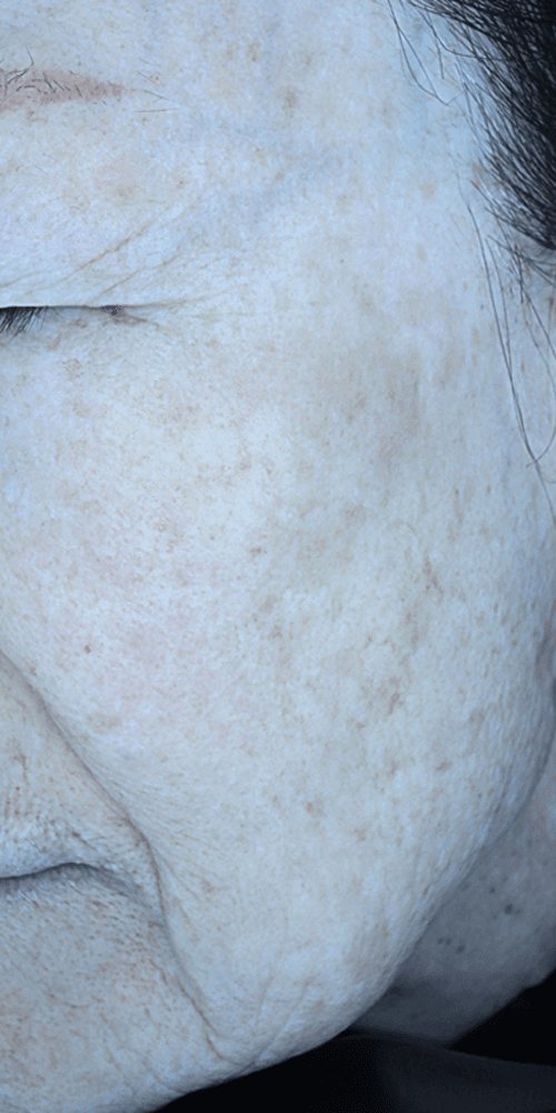 Pigmentation - After