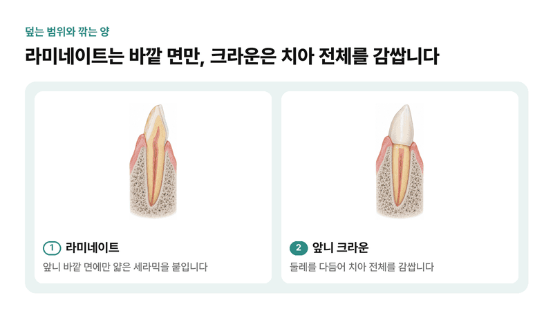 앞니 바깥 면만 덮는 라미네이트와 치아 둘레를 다듬어 전체를 감싸는 앞니 크라운의 덮는 범위와 깎는 양을 단면으로 비교한 일러스트