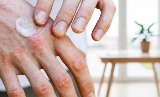 Крем на руках з пошкодженою шкірою
