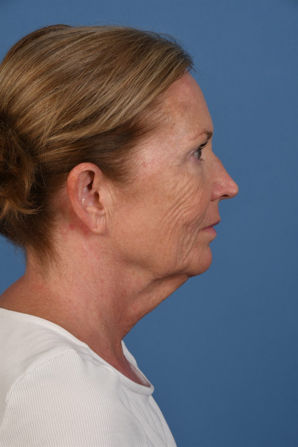 Facelift patient before surgery, profile, right side