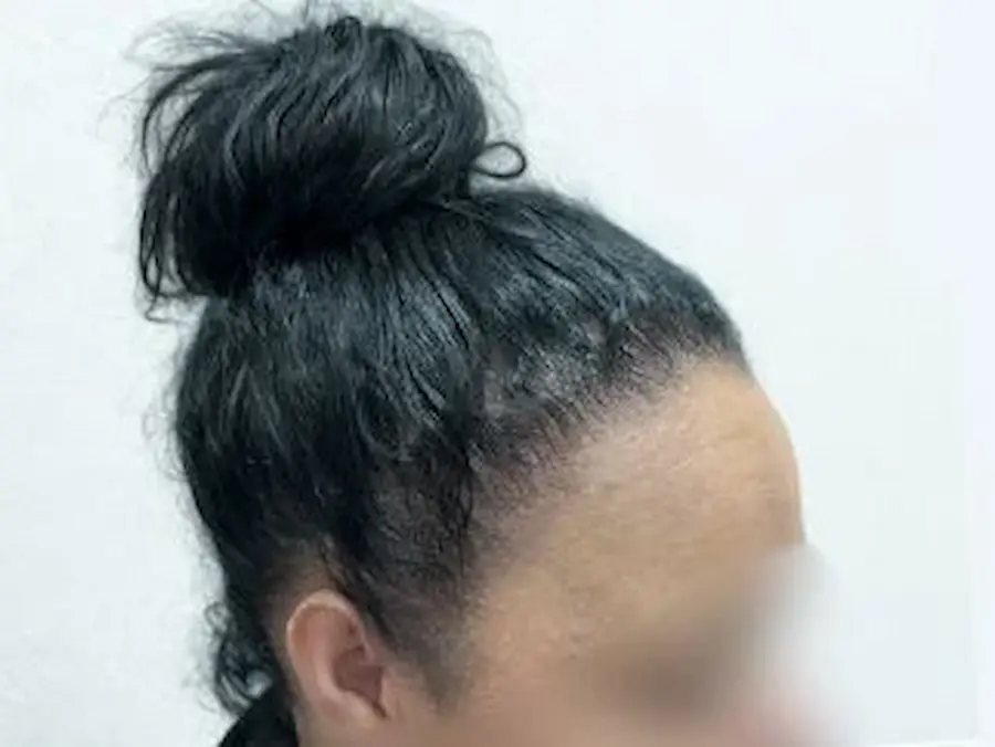 After hair transplant – Female FUT Hair Transplant