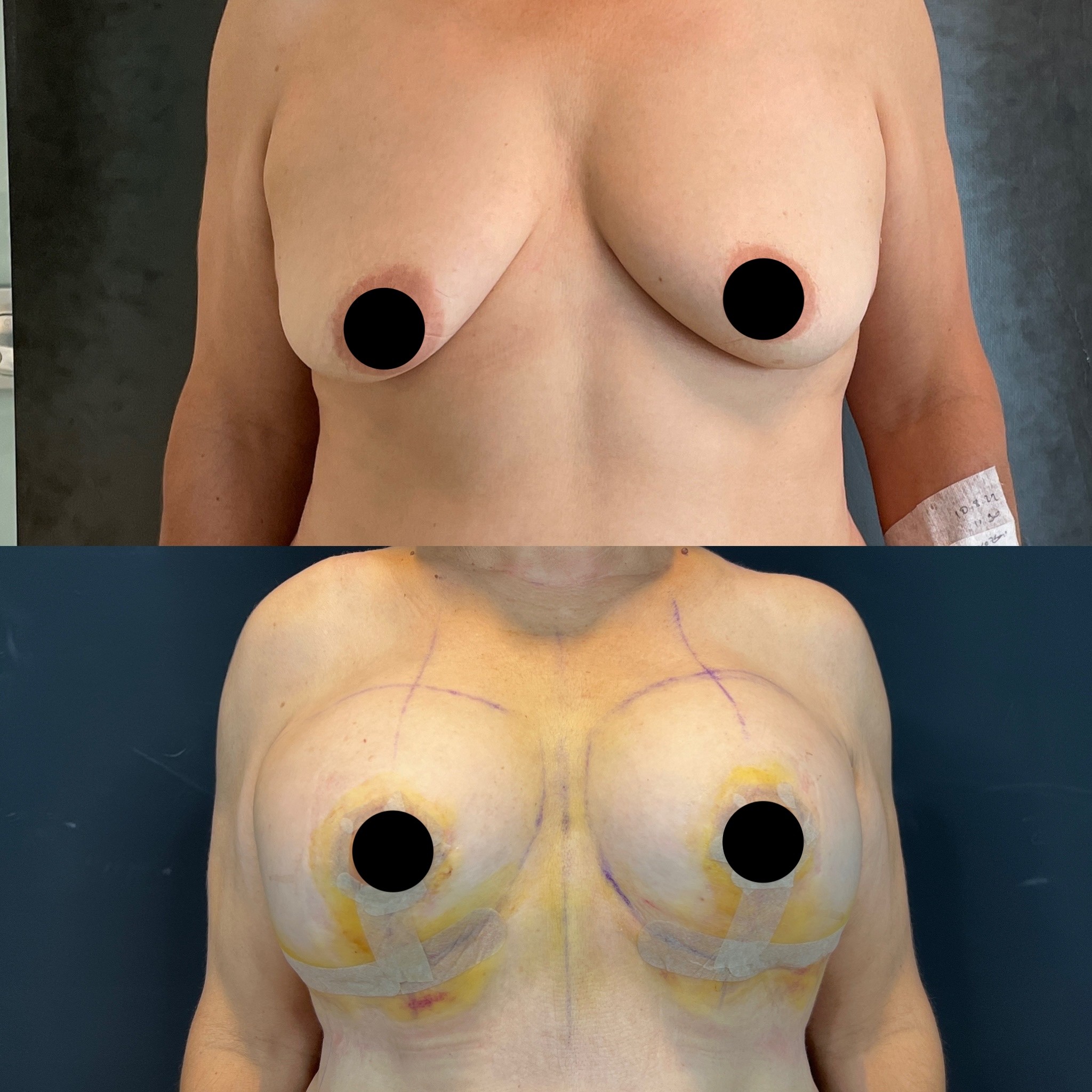 tuberous breast before after tubular breast front view