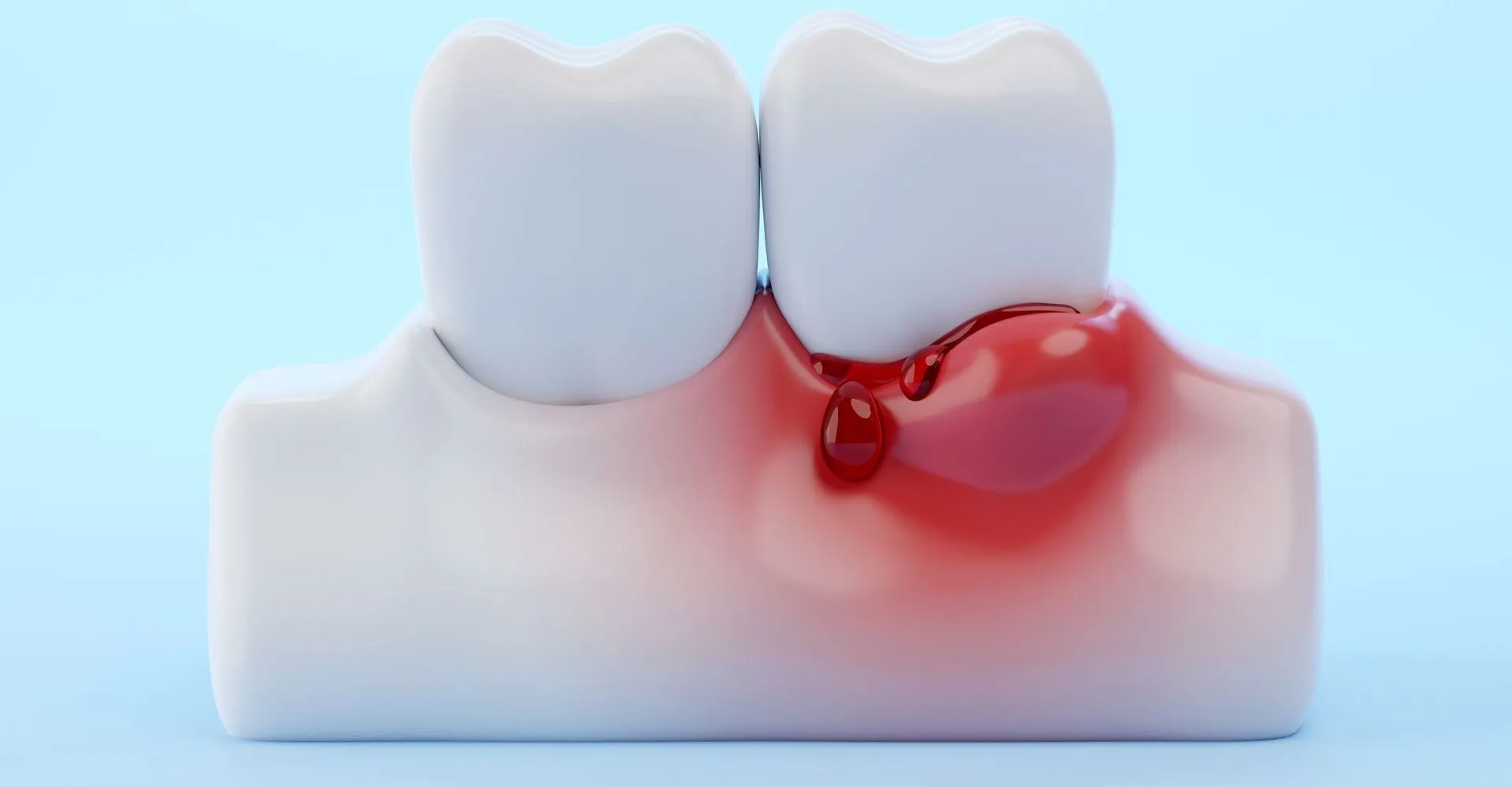 Quer Parar de Sangrar das Gengivas?