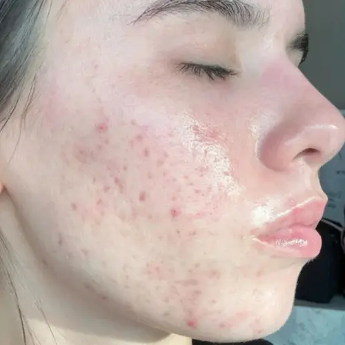 After lipids and ceramides treatment at The Vancouver Aesthetician — hormonal acne marks healing, skin barrier restored, and complexion visibly hydrated and healthy