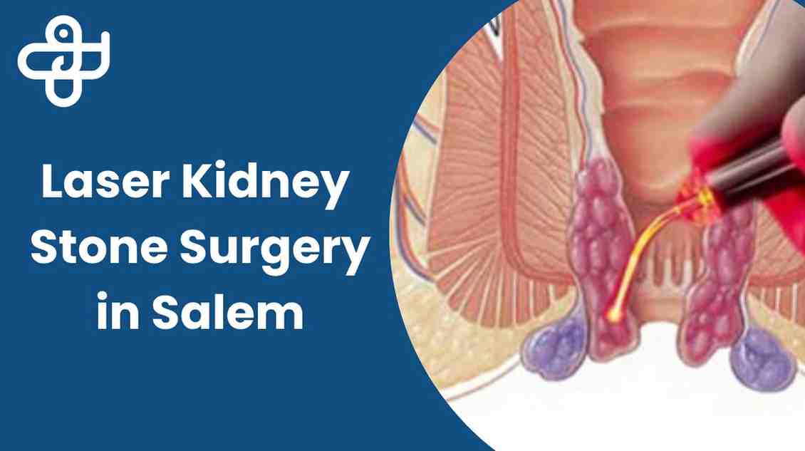 Laser Kidney stone surgery in Salem