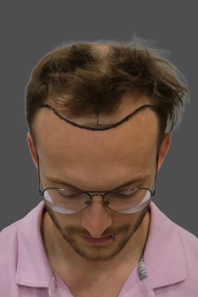 Ausgeprägte Geheimratsecken vor der Haarverpflanzung in der Partnerklinik