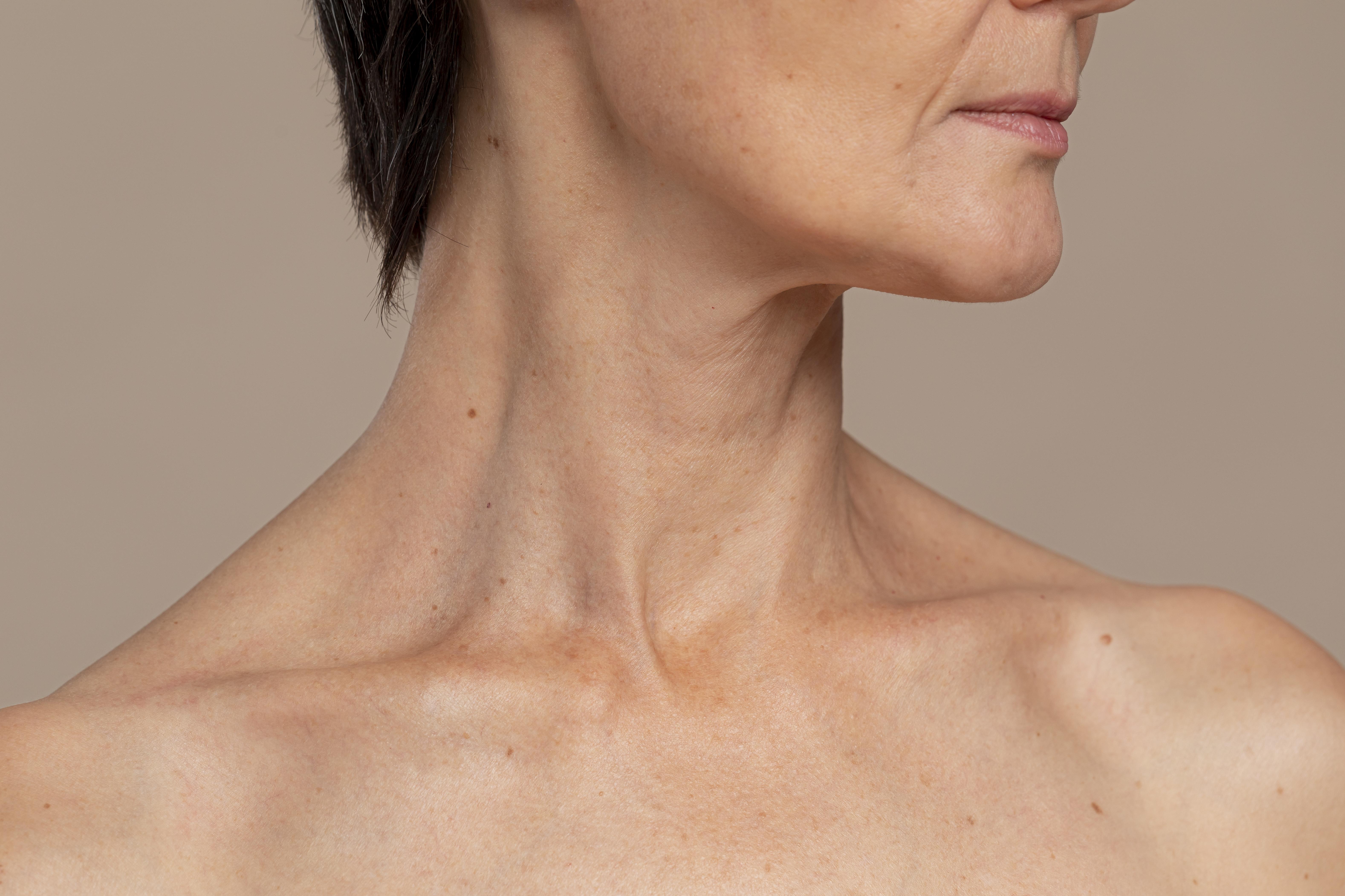 Neck Lift en Terrasa, Heaven Clinics