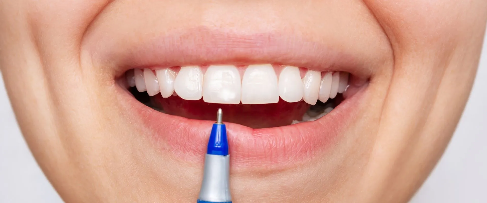 Manchas nos Dentes ou Fluorose Dentária?