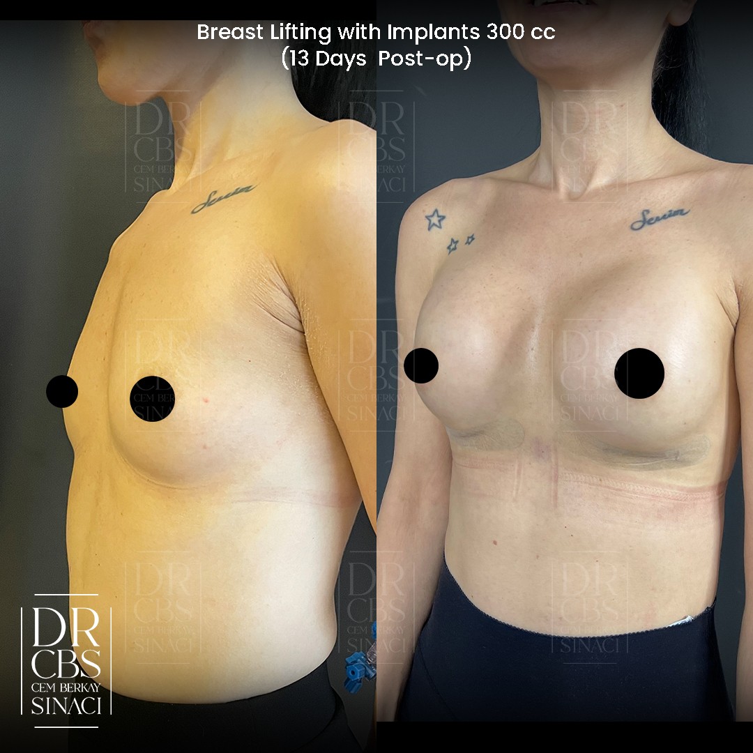 breast implant before after oblique view