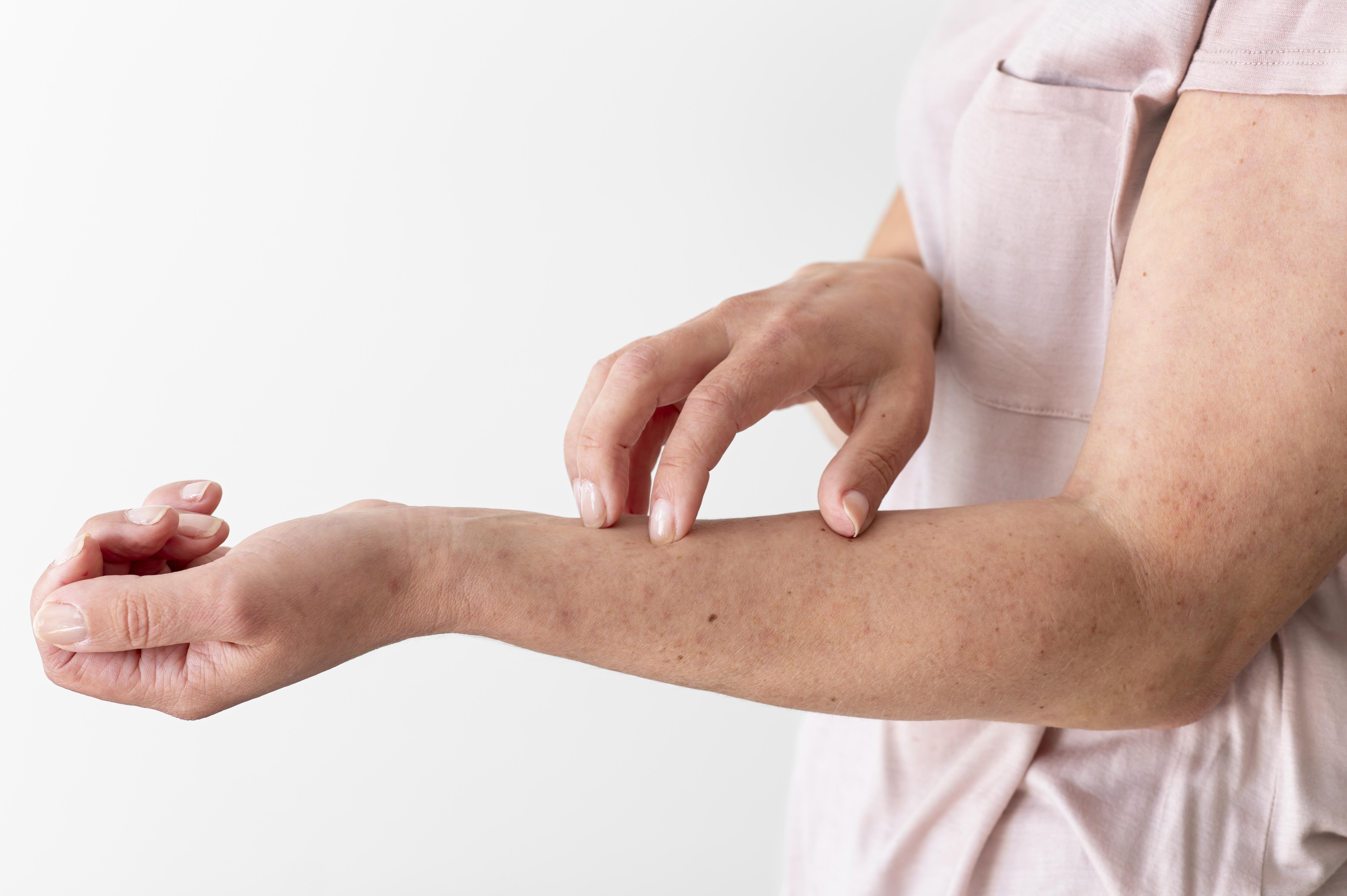 psoriasis placa piel inflamada