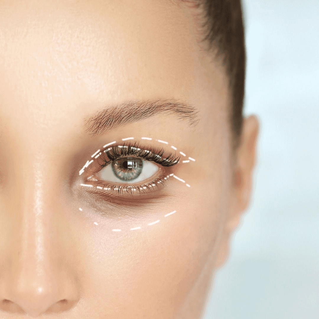 Blefaroplastia completa en Terrasa, Heaven Clinics