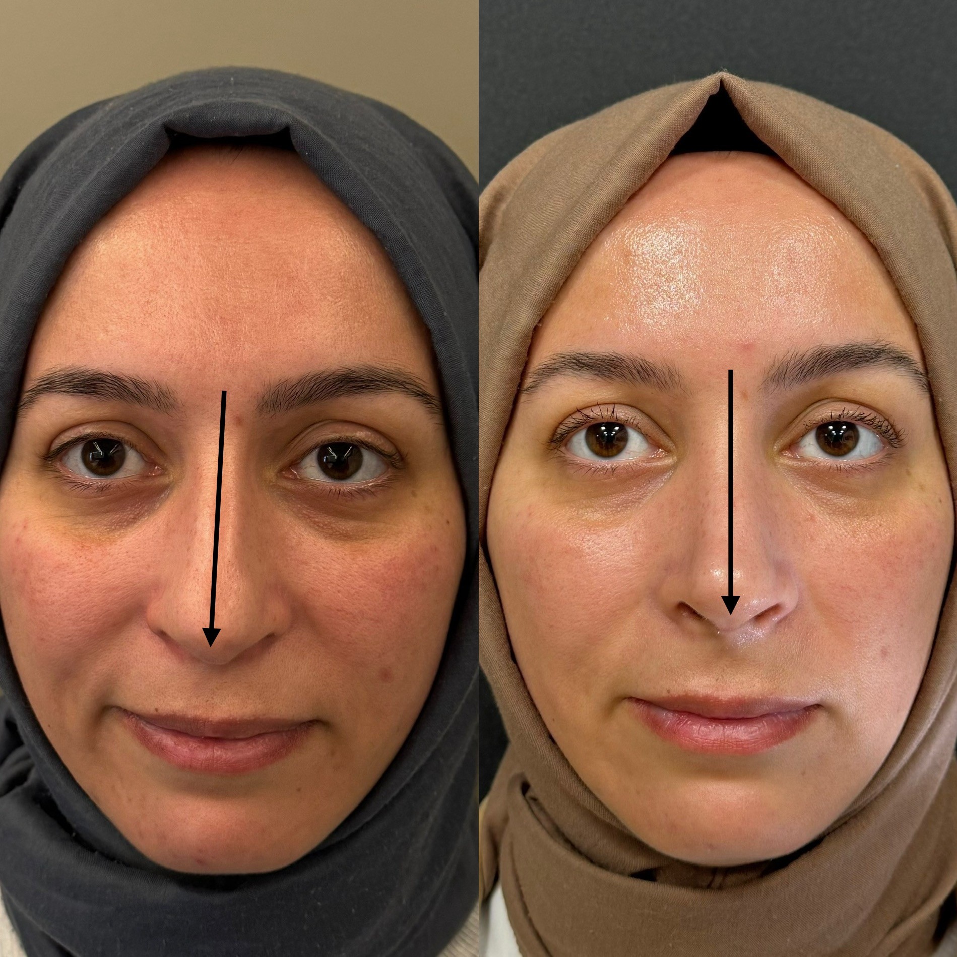 1 month rhinoplasty patient before after front view