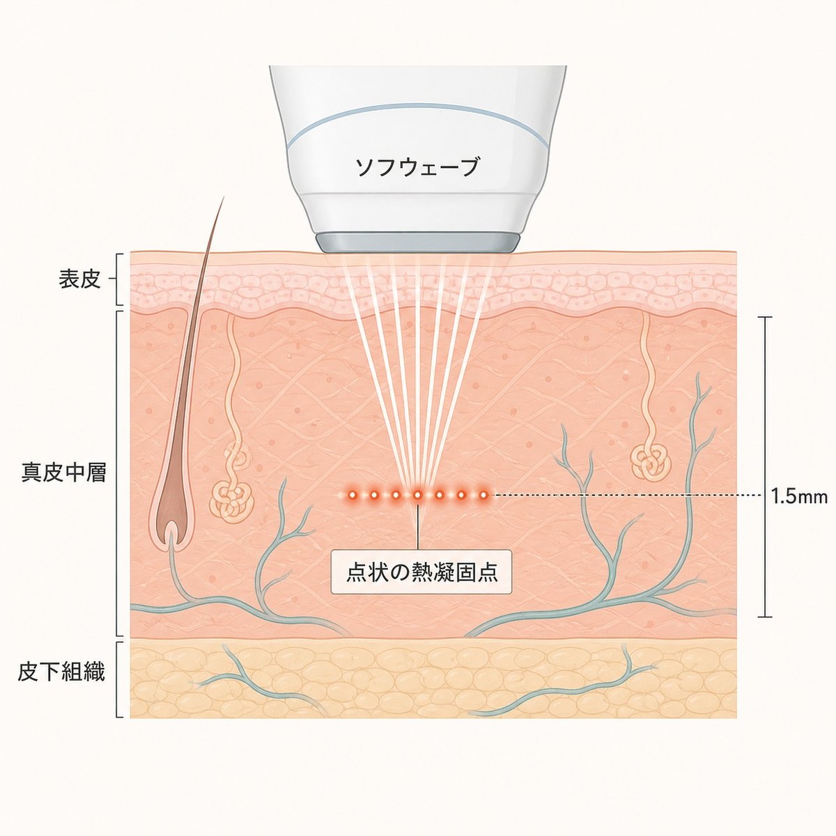 ソフウェーブの超音波が真皮中層に点状の熱凝固点をつくる仕組みを示した断面図