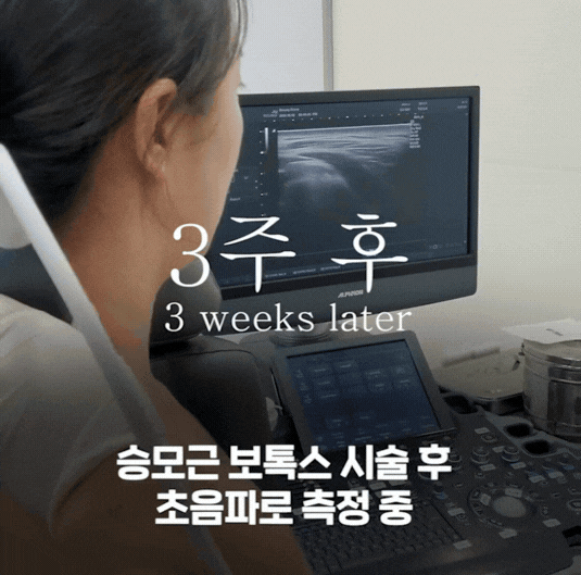 잘못된 위치의 보톡스는 독입니다: 승모근 상부와 주변 근육의 해부학적 진실