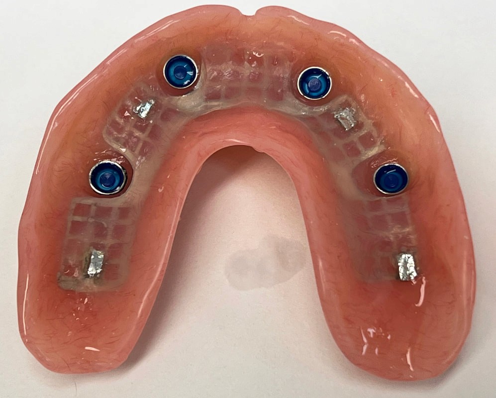 implant supported dentures in Smyrna