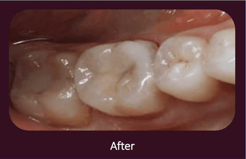 composite fillings