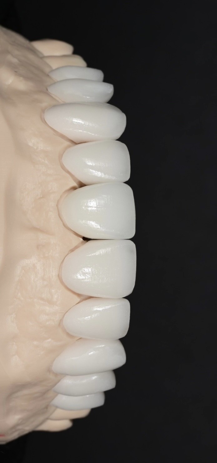 Erik’s finished porcelain veneers on the working model