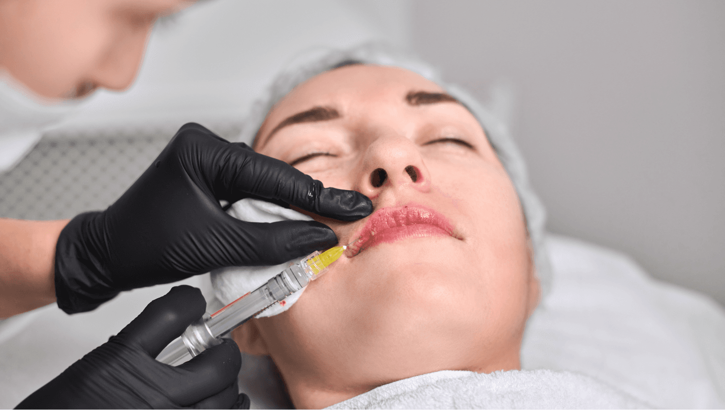 How Long Do Lip Fillers Last? Full Timeline Explained