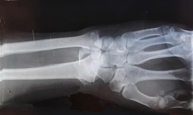 Bone fracture illustration