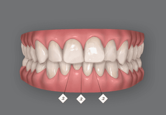 overbite is one of the issues treated with clear braces by Invisalign at Bella clinic in Abu Dhabi