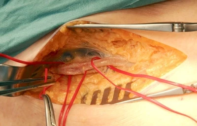 Femoral artery exposure