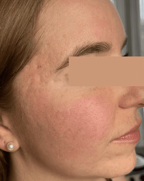 Helix Fusion acne scar removal after results.