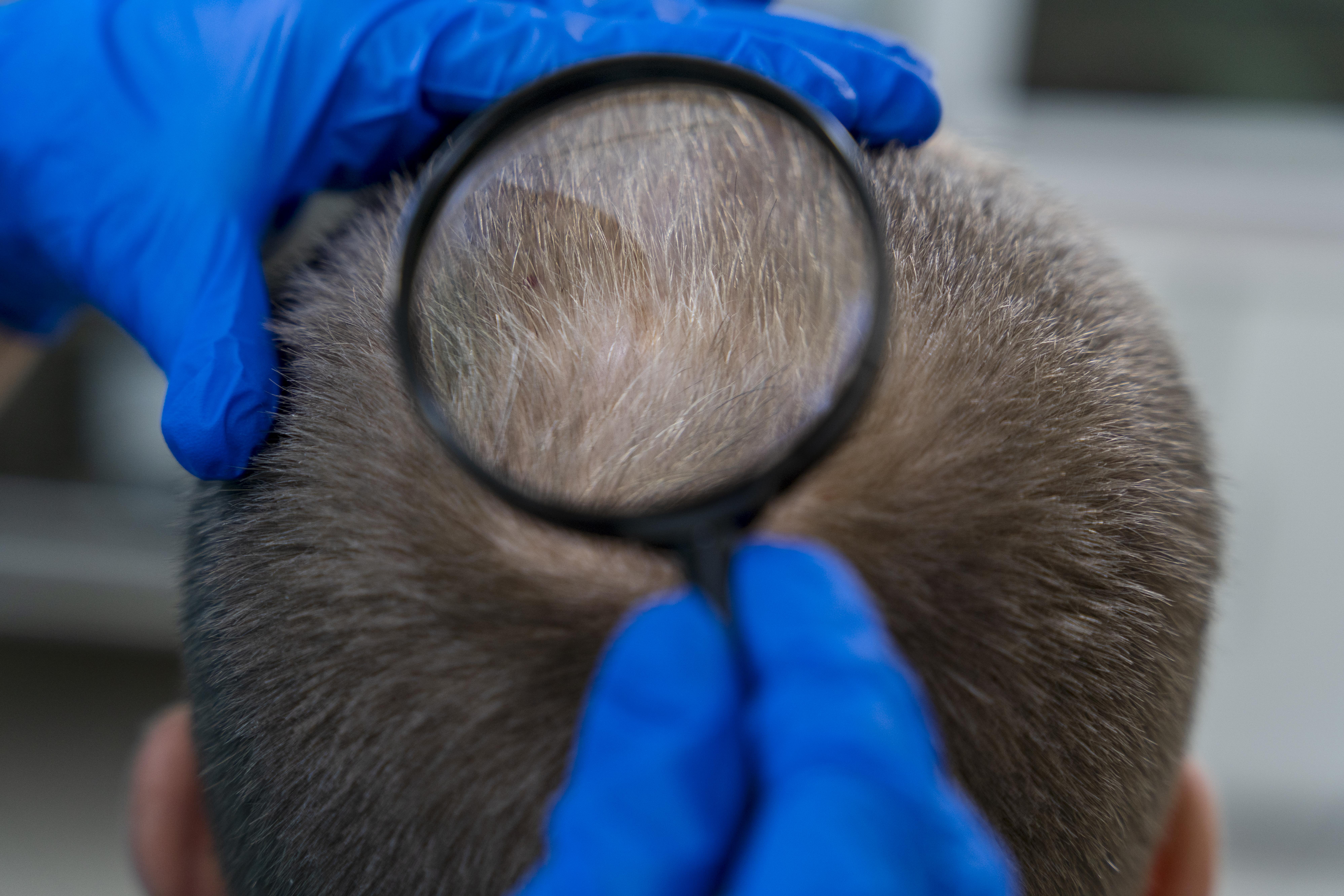 estudo de alopecia androgenetica