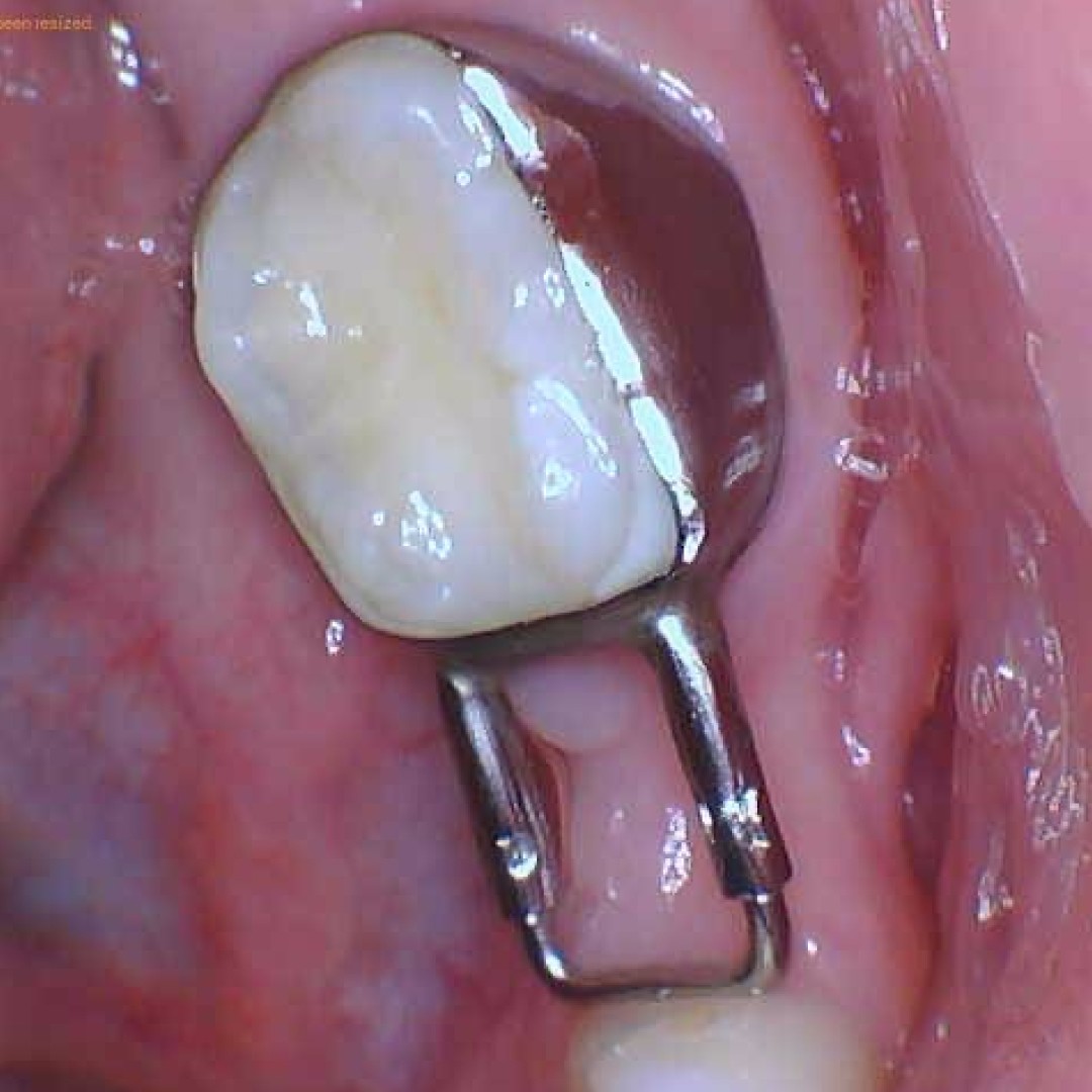 Close-up of a custom-fit dental space maintainer appliance used in pediatric dentistry to prevent crowding.