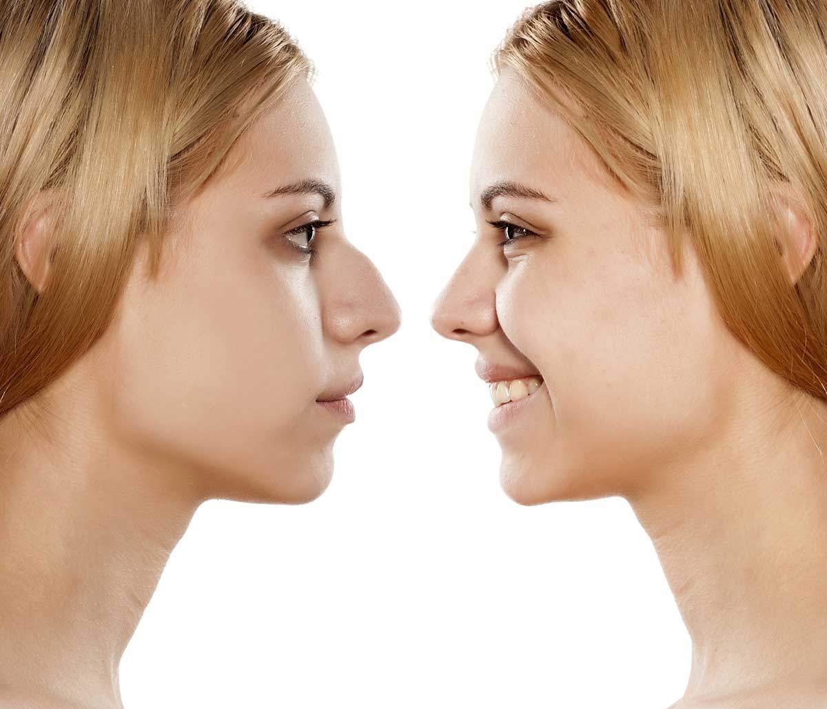 Rinoplastia en Terrasa, Heaven Clinics