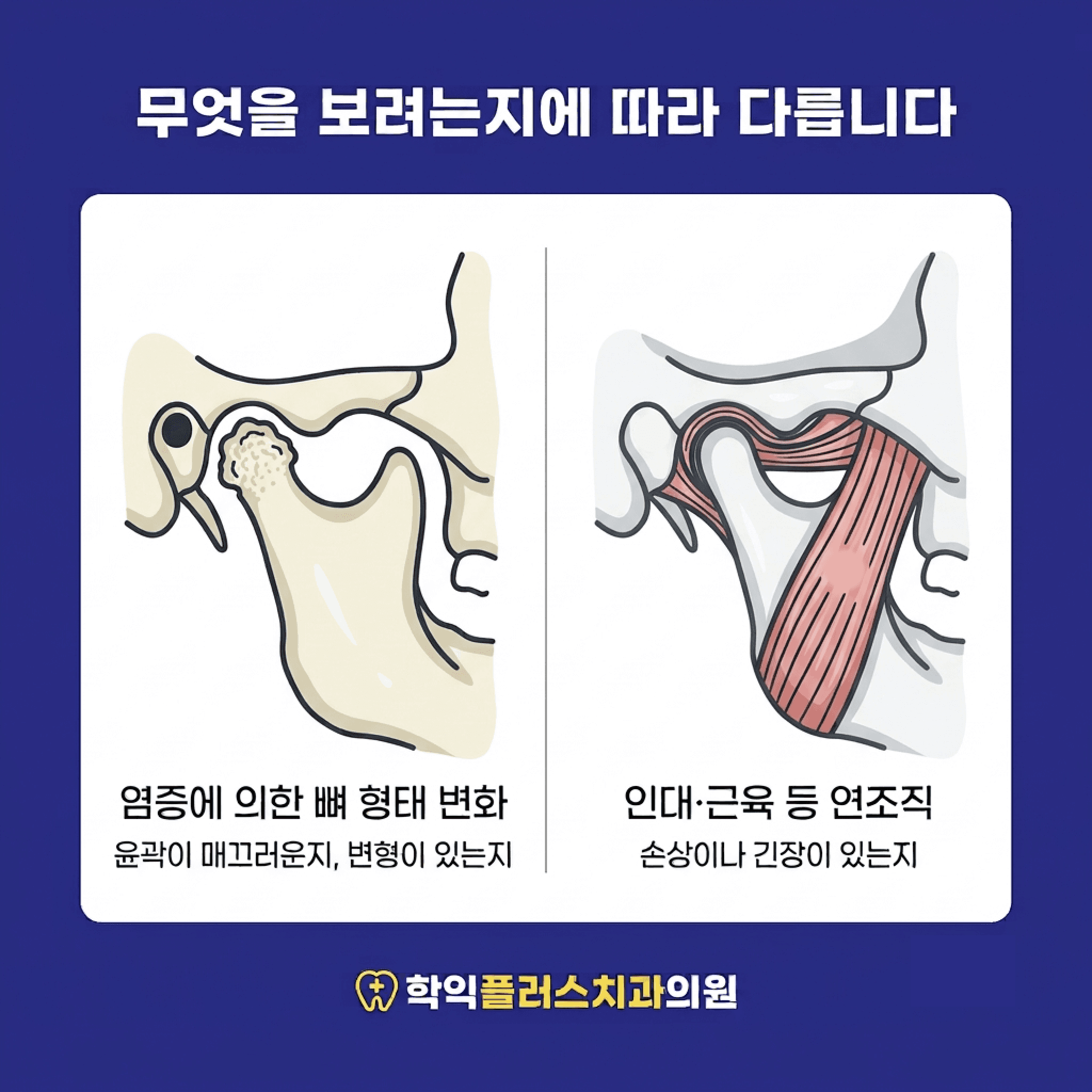 영상 검사에서 감별하는 두 영역 — 염증에 의한 뼈 형태 변화와 인대·근육 같은 연조직