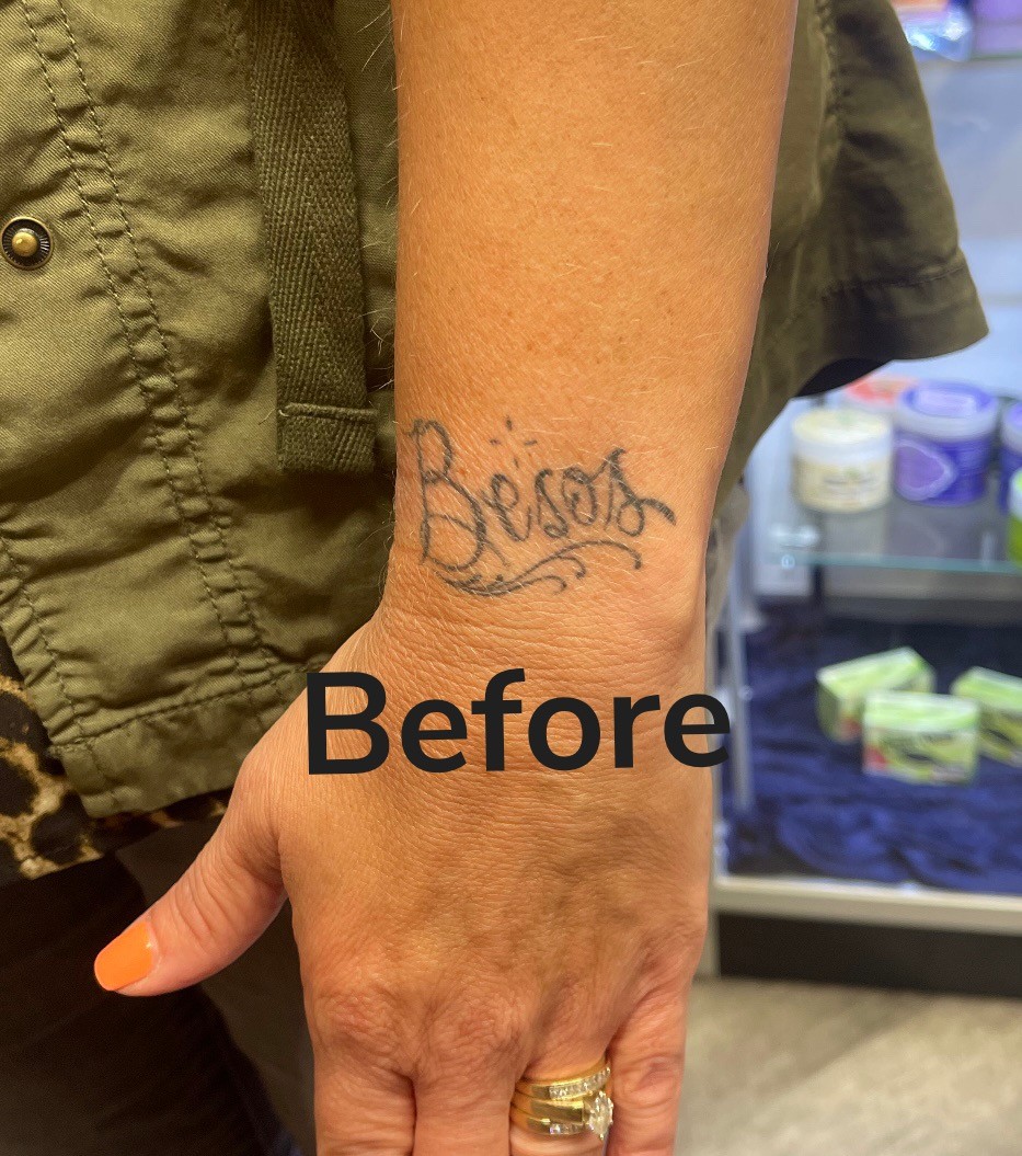 Before: faded "Besos" script tattoo on the wrist